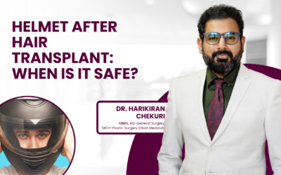 Helmet After Hair Transplant: When Is It Safe?