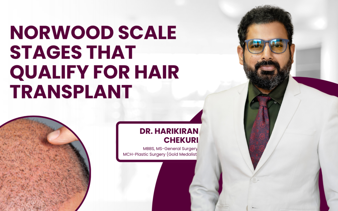Norwood Scale Stages That Qualify for Hair Transplant