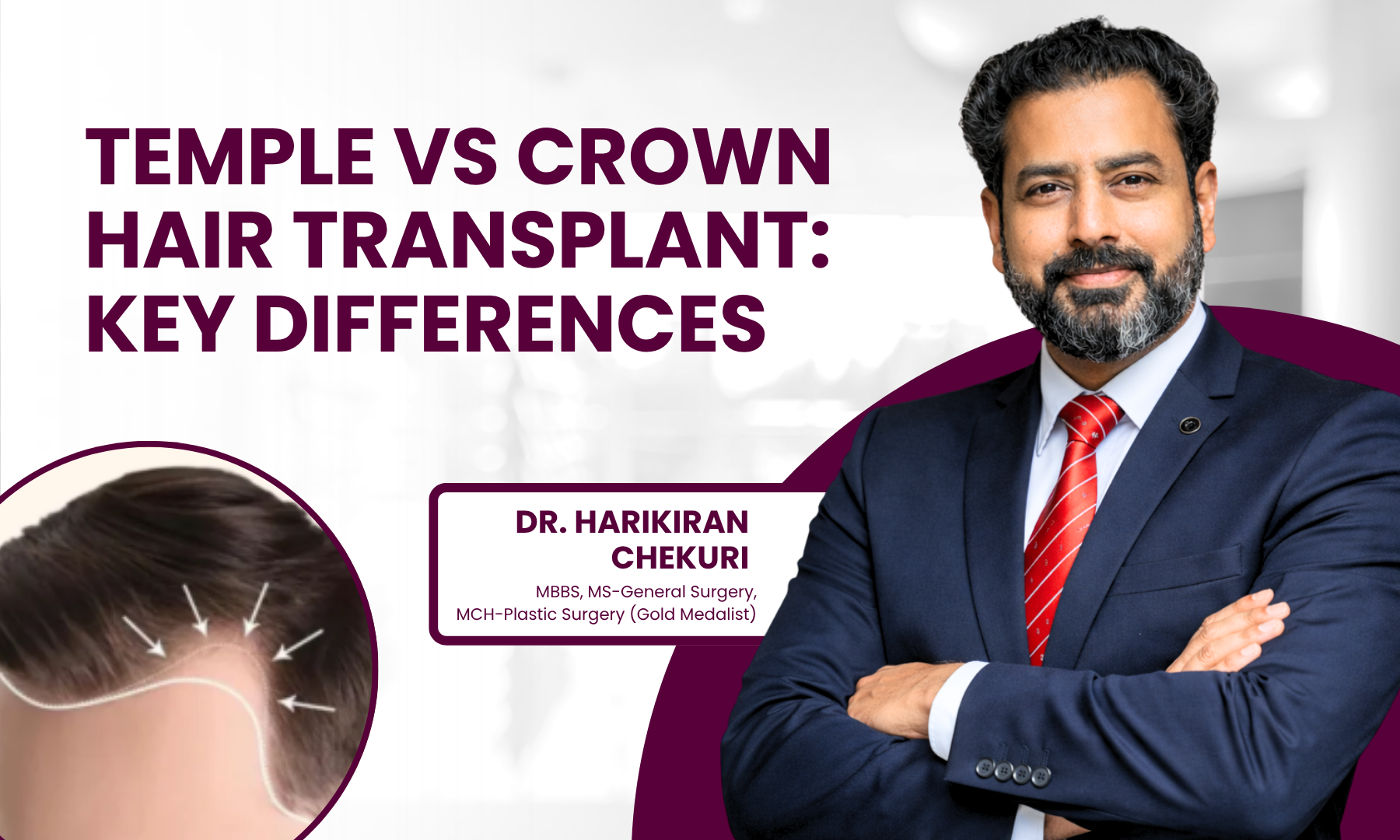 Informational banner on temple vs crown hair transplant differences with Dr. Harikiran Chekuri on the right.