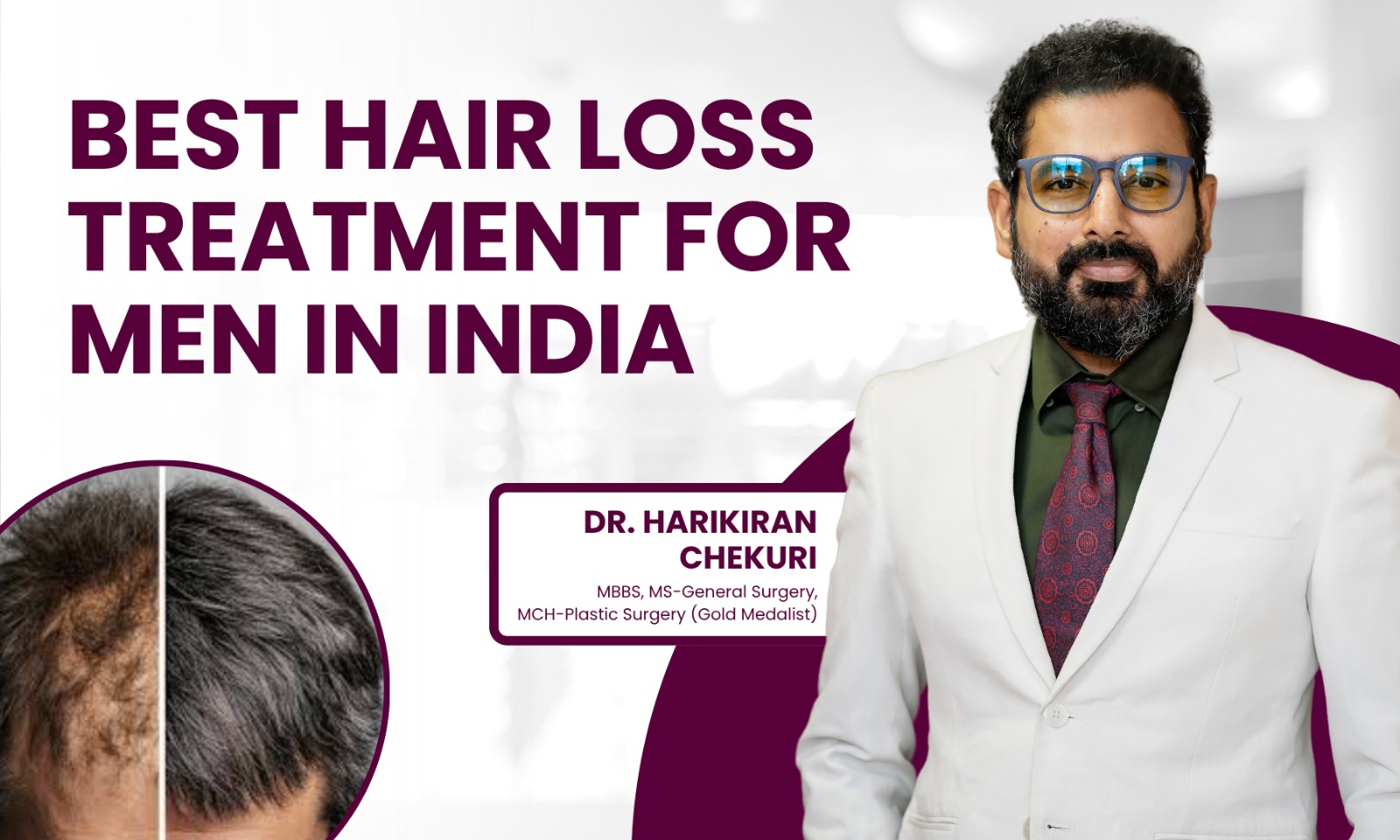 Best Hair Loss Treatment for Men in India - Dr. Harikiran Chekuri