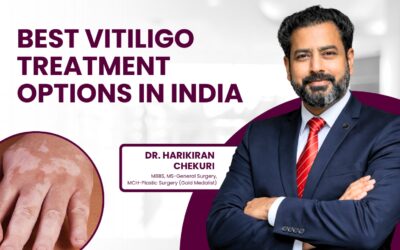 Best Vitiligo Treatment Options in India?