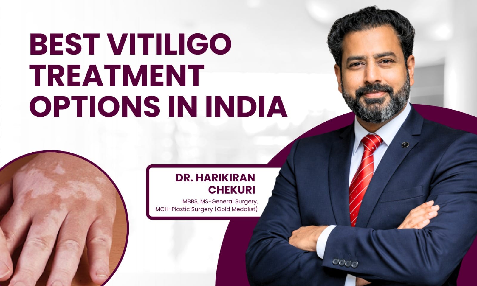 Best Vitiligo Treatment Options in India - Dr. Harikiran Chekuri