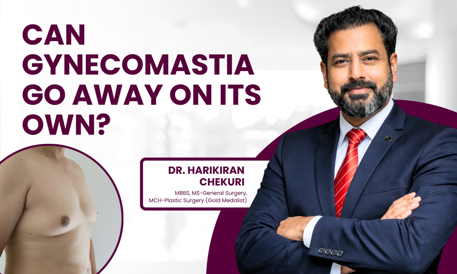 Can Gynecomastia Go Away on Its Own - Dr. Harikiran Chekuri
