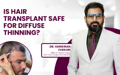 Is Hair Transplant Safe for Diffuse Thinning?
