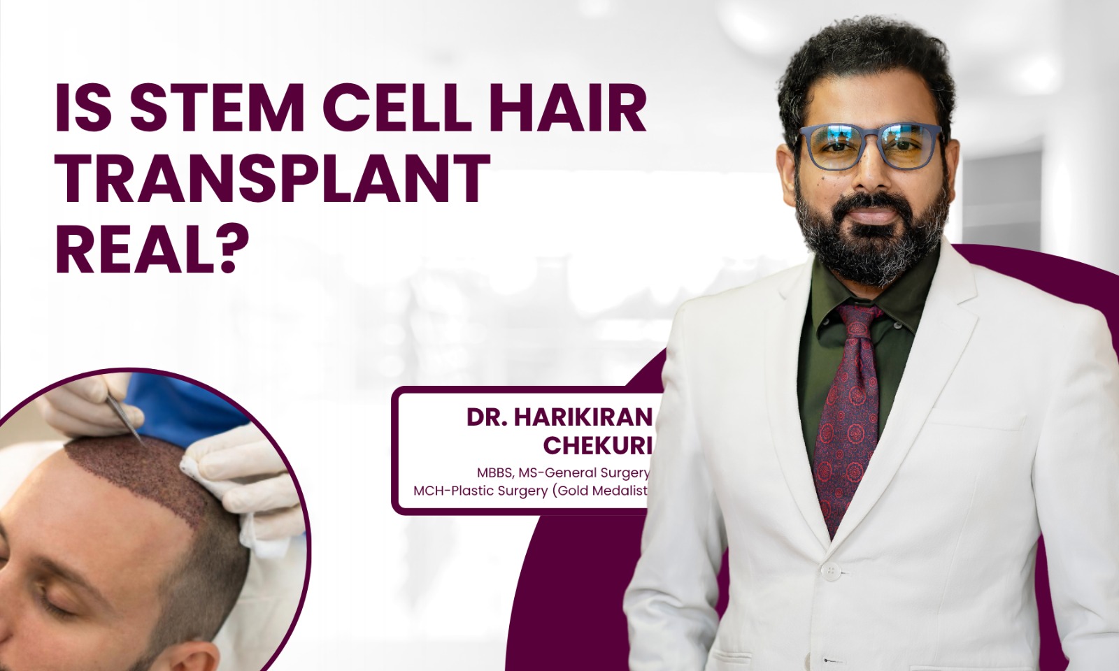 Stem Cell Hair Transplant in Hyderabad - Dr. Harikiran Chekuri