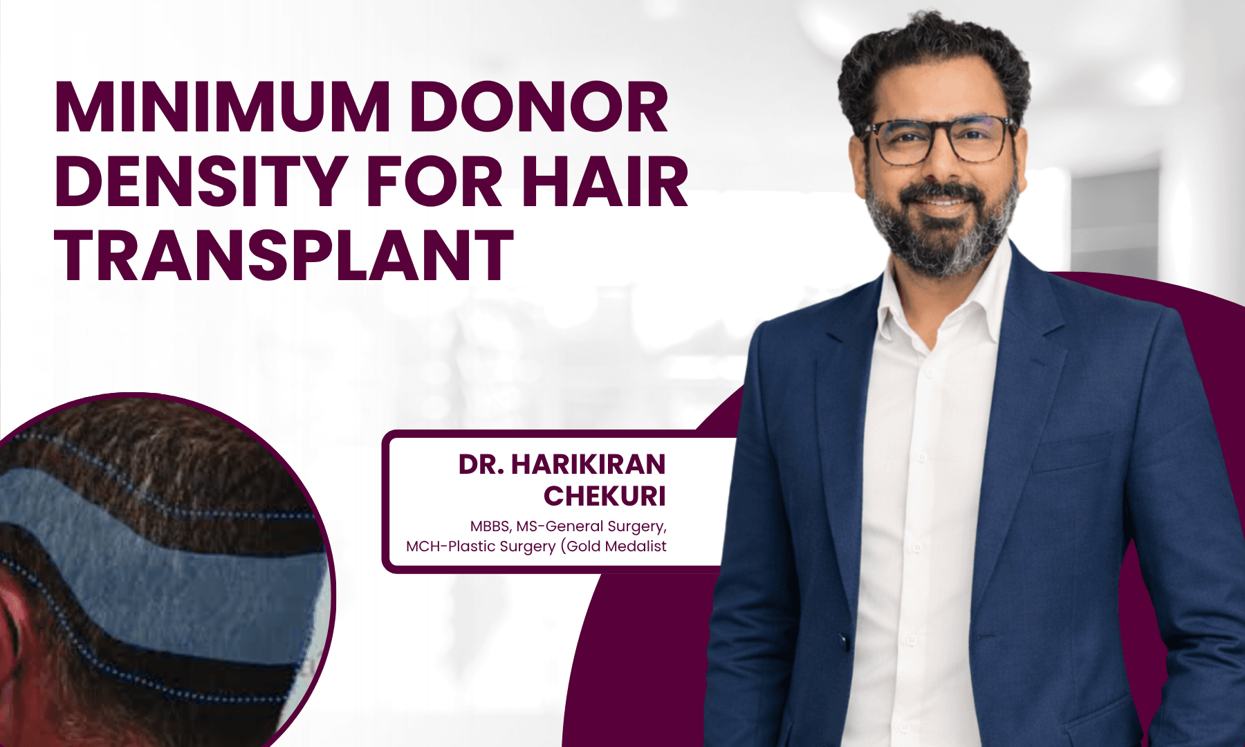 Minimum Donor Density for Hair Transplant | Redefine Best Vitiligo Treatment Options in India - Dr. Harikiran Chekuri
