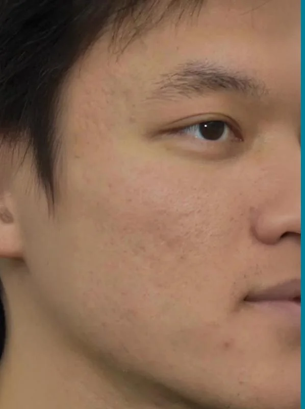 p1 | Redefine Before-and-after comparison of a man’s cheek showing reduced acne scars and smoother skin after treatment, split by a teal divider.