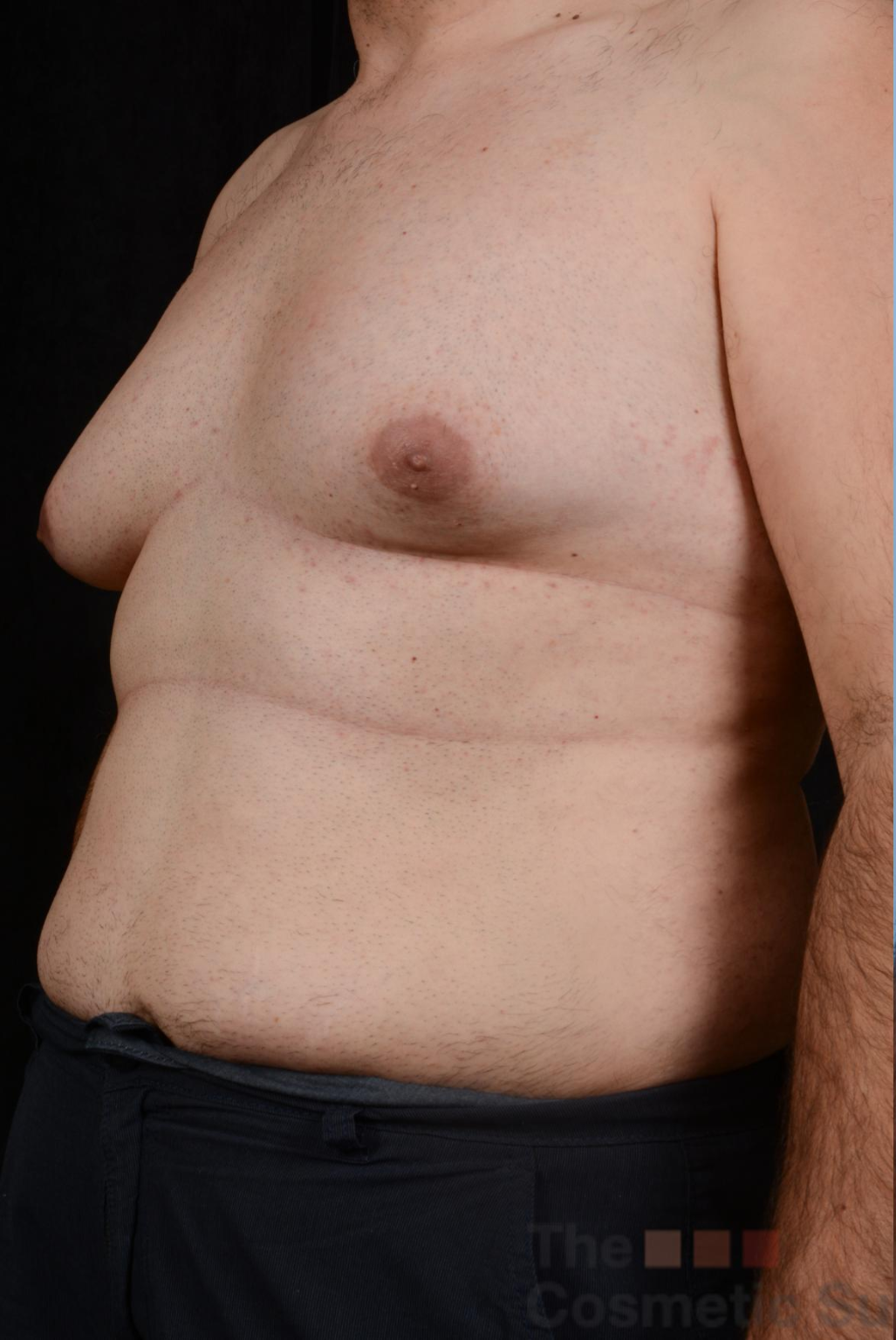 p1 | Redefine Side-by-side image of a man's chest before (left) and after (right) treatment, showing reduced chest fullness after the procedure.