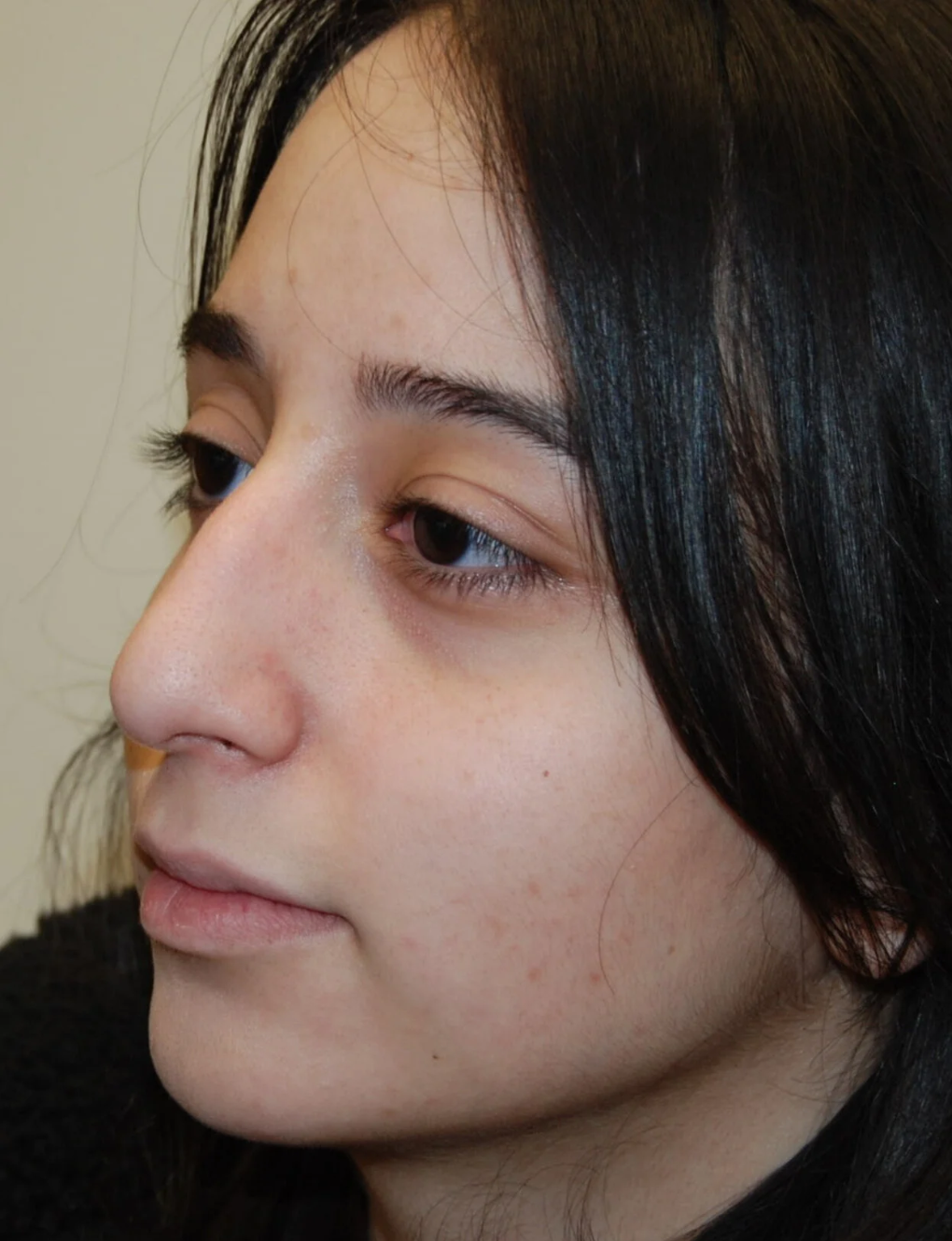 p1 | Redefine Before (left) and after (right) close-up profile of a woman's face, highlighting subtle changes around the nose and eye area.