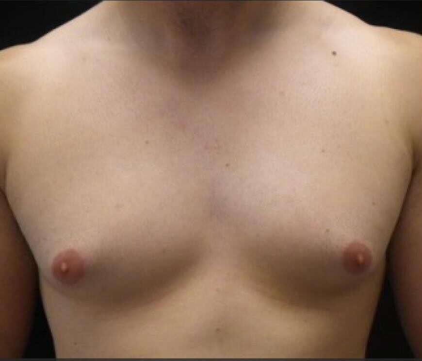 p1 | Redefine Before and after comparison of a man's bare chest; left with minimal hair, right with noticeably increased chest hair after treatment.