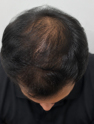 p1 | Redefine Top-down view of a man's balding crown with thinning hair and visible scalp.