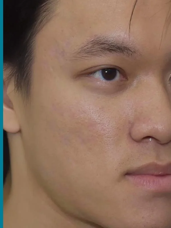 p2 | Redefine Left: acne-prone cheek before treatment; right: clearer, smoother skin after treatment on a young man's face.