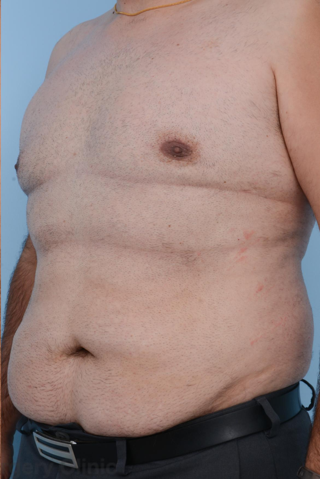 p2 | Redefine Left: acne-prone cheek before treatment; right: clearer, smoother skin after treatment on a young man's face.