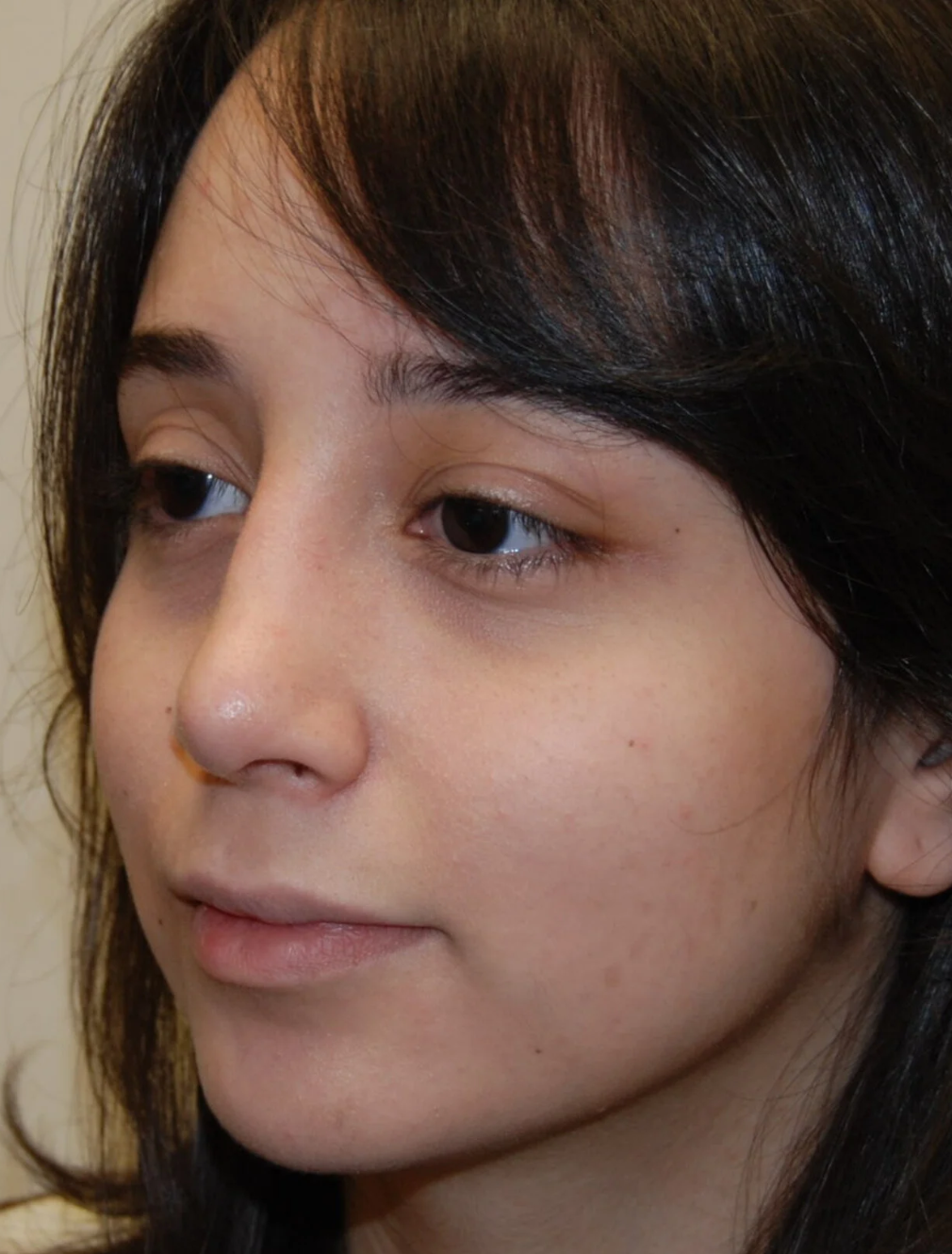 p2 | Redefine Two-panel side-by-side headshots of a woman showing before (left) and after (right) facial refinements, focusing on the eye and cheek area.