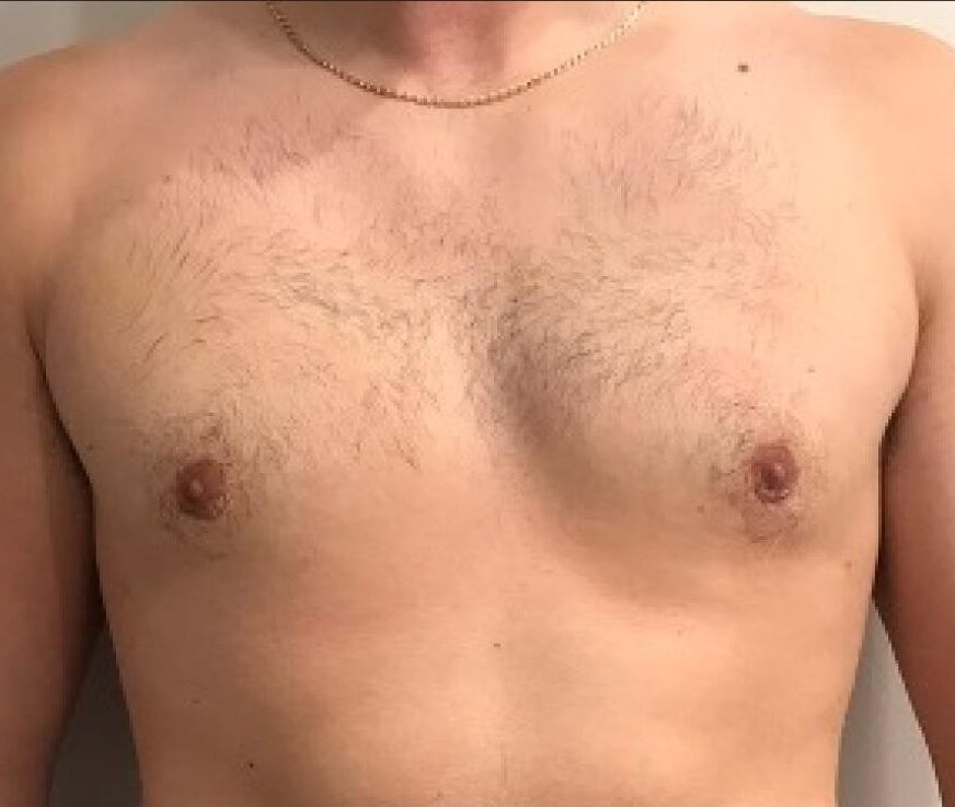 p2 | Redefine Before/after comparison of a man's bare chest showing a fuller, hairier chest on the right and a smoother, flatter chest on the left.