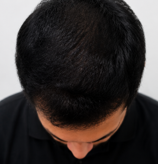 p2 | Redefine Top-down view of a person with short black hair wearing a dark shirt, looking downward at the scalp area