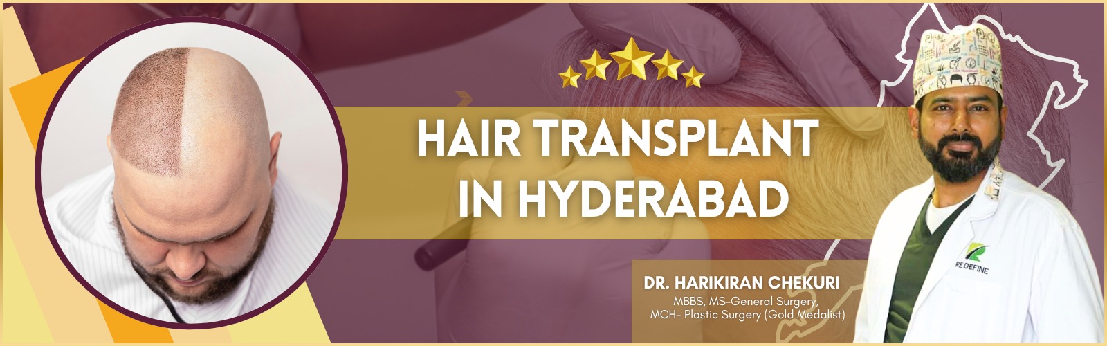 Best Hair Transplant in Hyderabad
