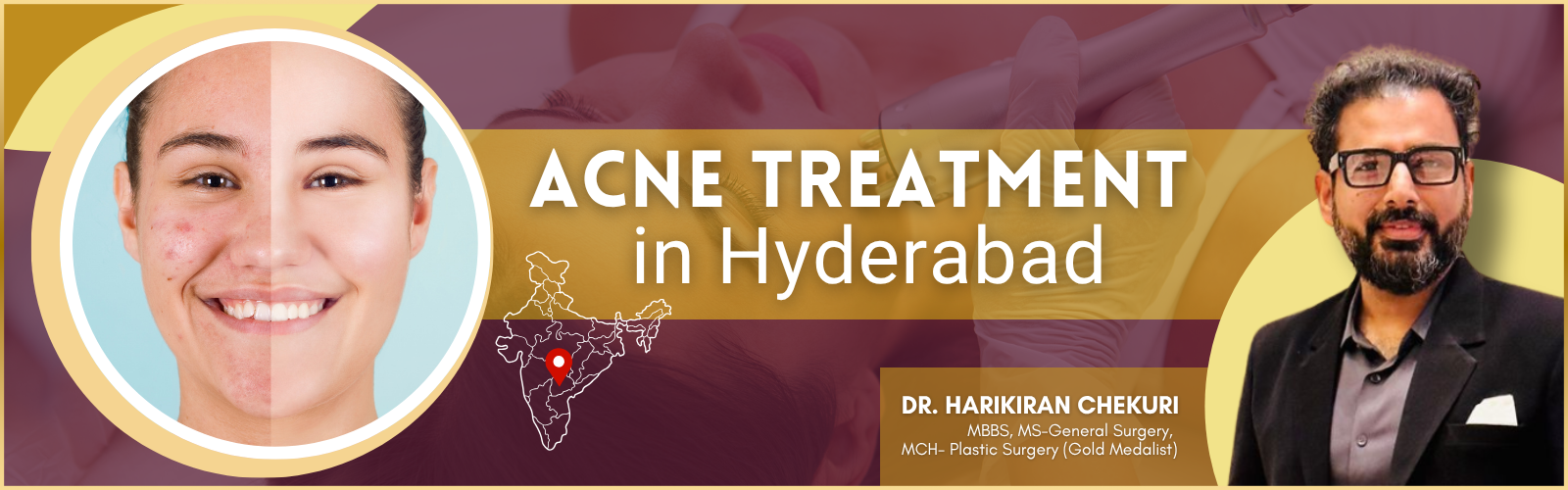 Promotional banner for acne treatment in Hyderabad with a split-face close-up on the left, a map pin on India, and Dr. Harikiran Chekuri on the right.