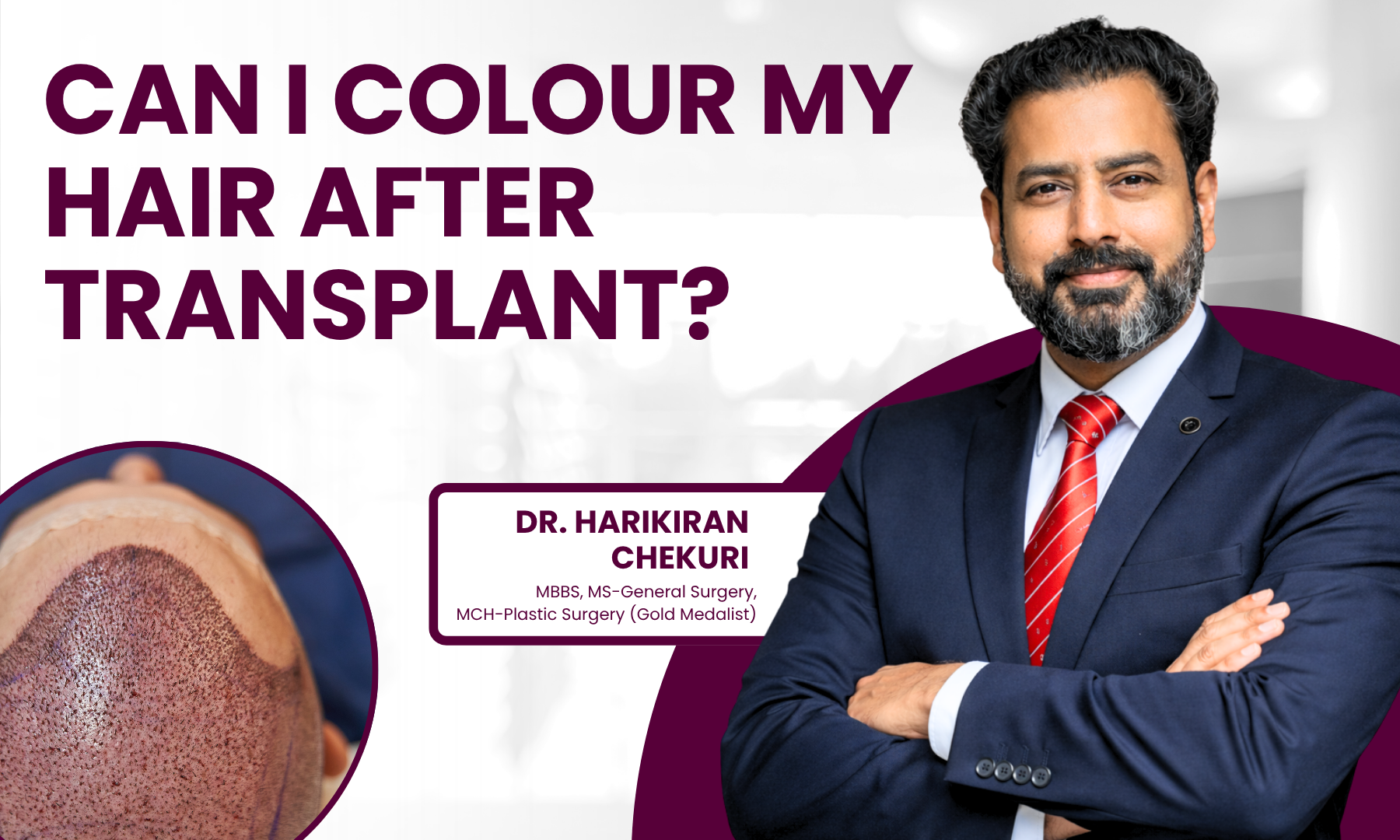 Can I Colour My Hair After Transplant | Redefine Can I Colour My Hair After Transplant - Dr. Harikiran Chekuri