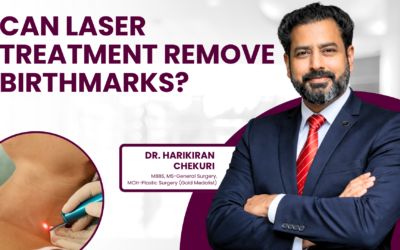 Can Laser Treatment Remove Birthmarks?