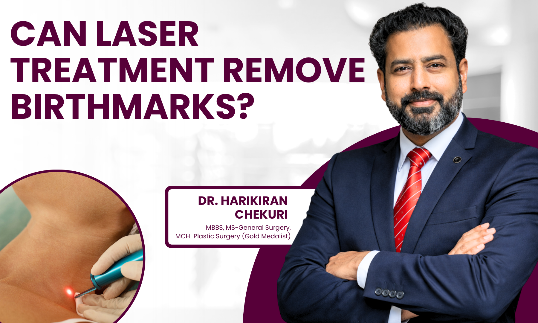 Can Birthmarks Be Removed by Laser Treatment - Dr. Harikiran Chekuri