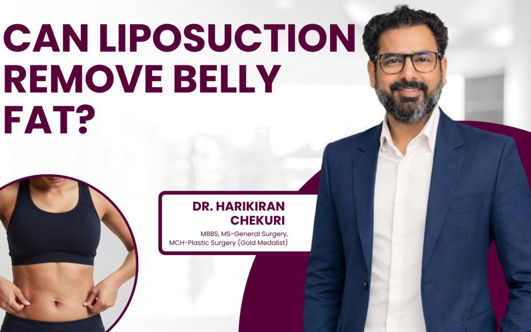 Can Liposuction Remove Belly Fat?