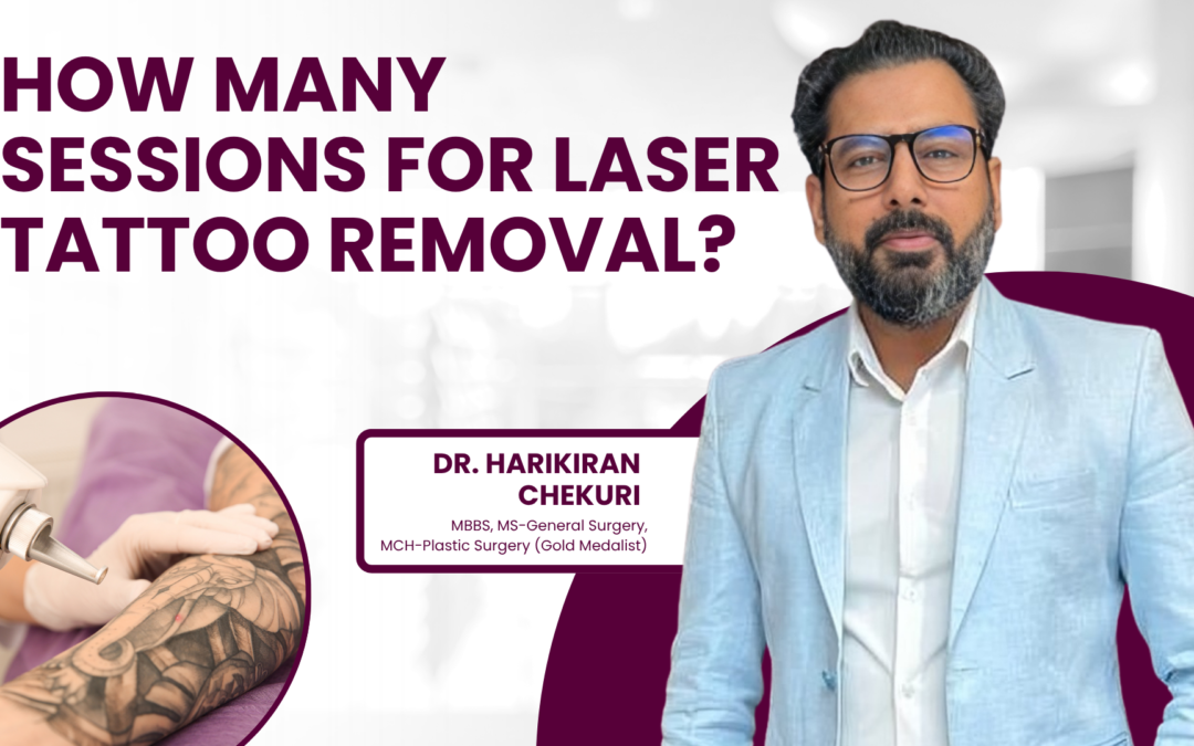 How Many Sessions for Laser Tattoo Removal?