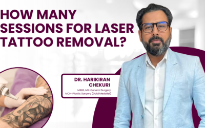 How Many Sessions for Laser Tattoo Removal?
