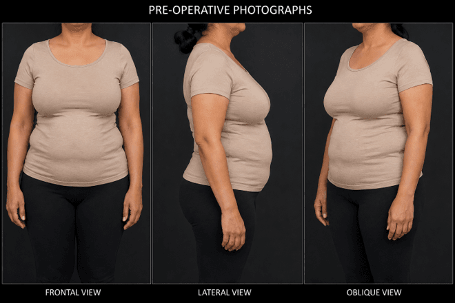 Pre-operative photographs of a woman shown from frontal, lateral, and oblique views in beige tee and black pants against a dark backdrop.