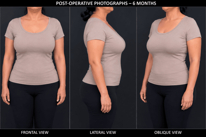 Three-panel photograph labeled Post-Operative Photographs – 6 Months showing frontal, side, and oblique views of a person in a beige top and black pants, six months post-surgery.