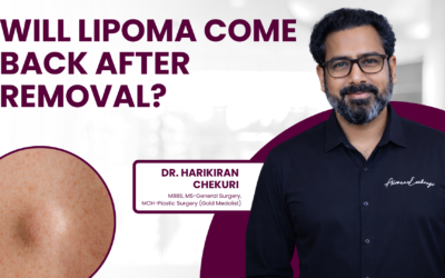 Will Lipoma Come Back After Removal?