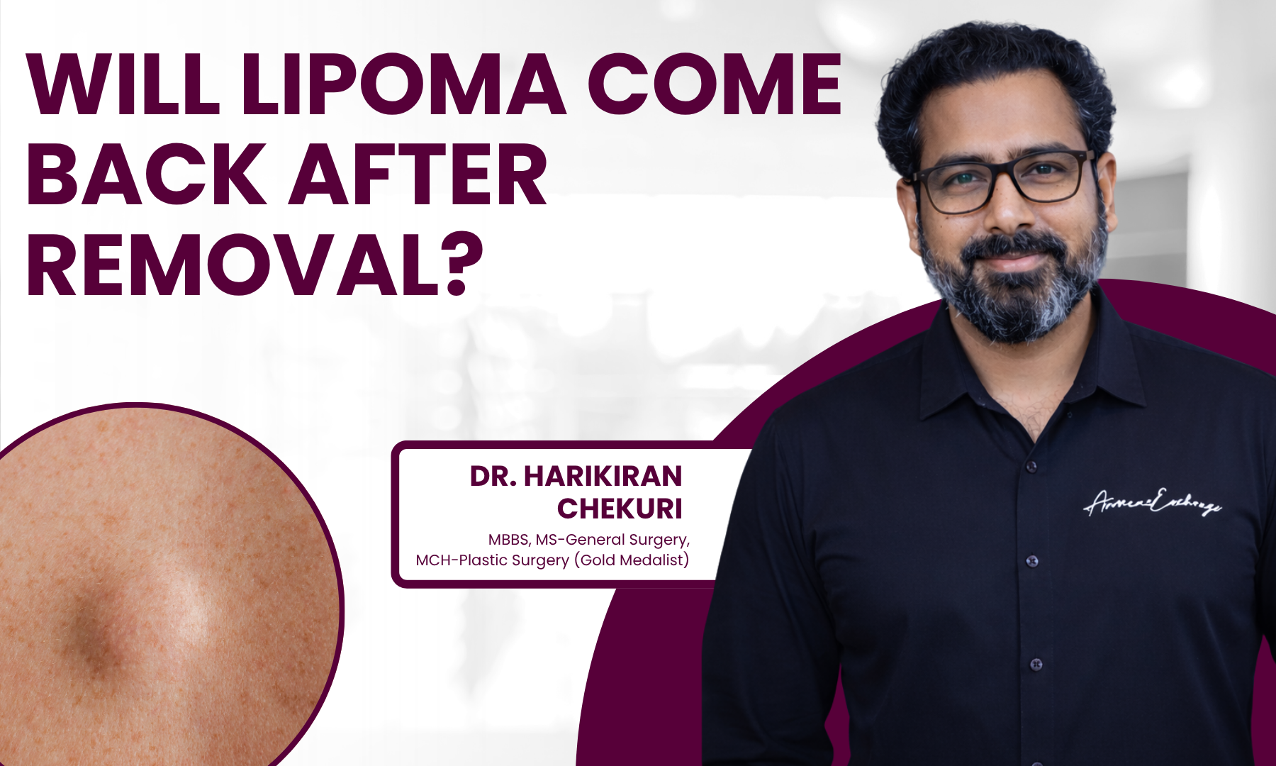 Will Lipoma Come Back After Removal | Redefine Will Lipoma Come Back After Removal - Dr. Harikiran Chekuri