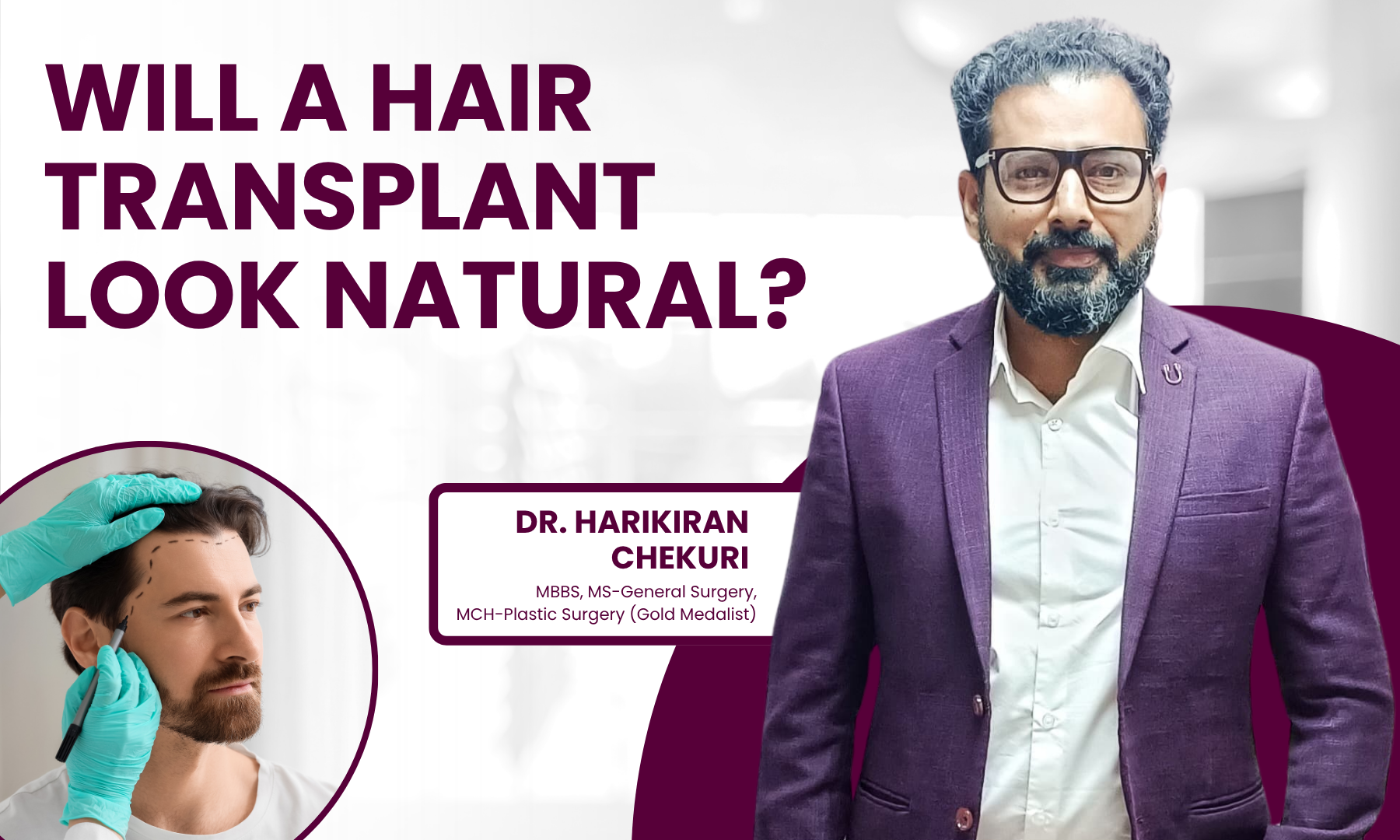 Will a Hair Transplant Look Natural | Redefine Will a Hair Transplant Look Natural - Dr. Harikiran Chekuri