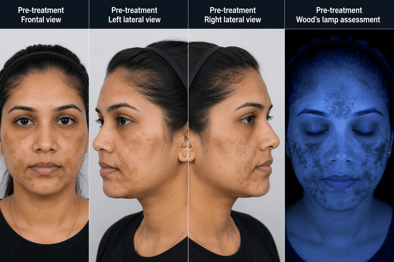 Front view of a woman with diffuse facial hyperpigmentation typical of melasma before treatment.