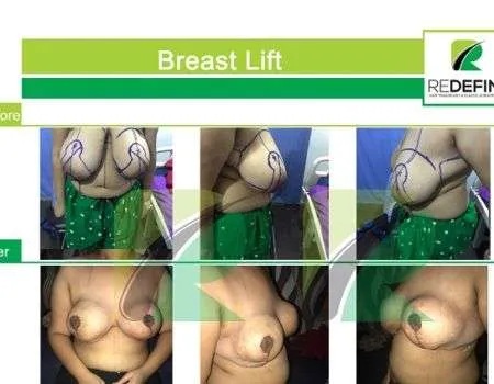 Collage showing before and after breast lift results, with a green 'Breast Lift' banner and REDEFINE clinic logo.