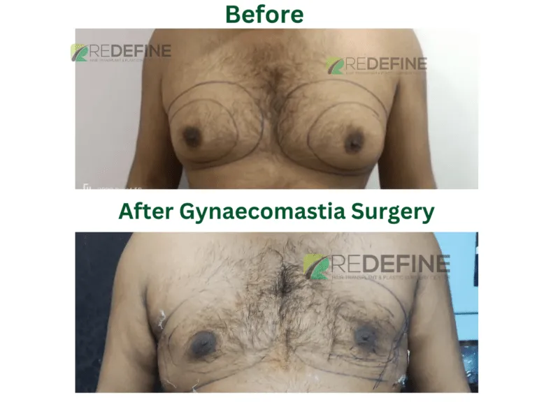 Before (top) and after gynecomastia surgery: male chest with reduced breast tissue and surgical markings in the top image; bottom shows flatter chest with healing marks and chest hair.