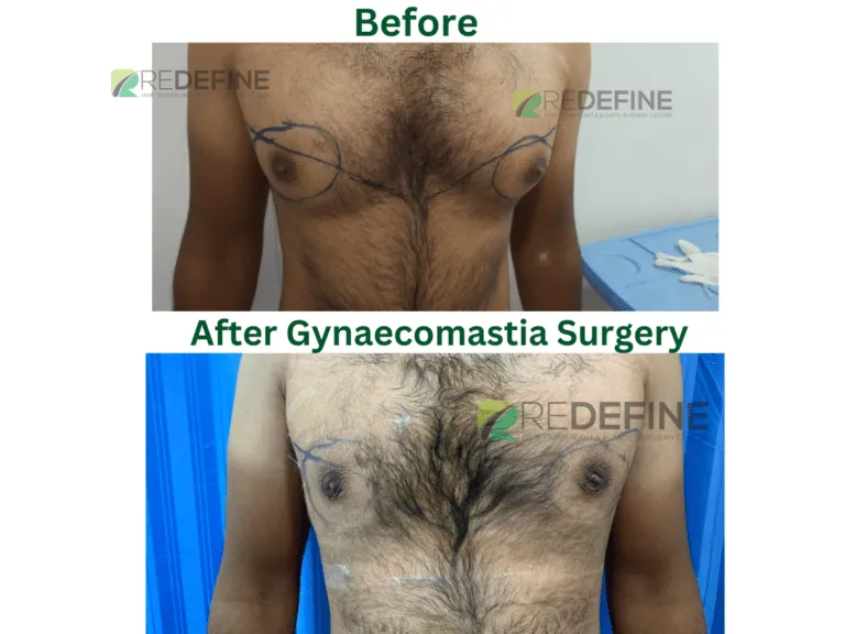 Before-and-after comparison of a man's chest showing gynecomastia surgery results; top: before, bottom: after surgery.