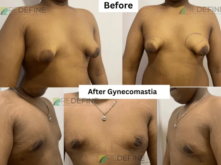 Composite showing before and after gynecomastia surgery: flatter chest with healed incisions.