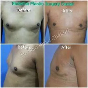 Four-panel before-and-after collage showing male chest contouring results after plastic surgery (Before on left, After on right).
