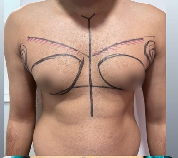 Pre-operative: frontal view showing bilateral Grade II gynecomastia with liposuction contouring zones (pink) and gland excision markings (black)