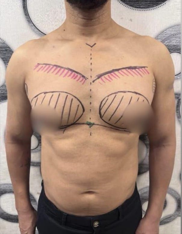 Pre-operative: frontal view with liposuction contouring zones (pink) and gland excision markings (black)