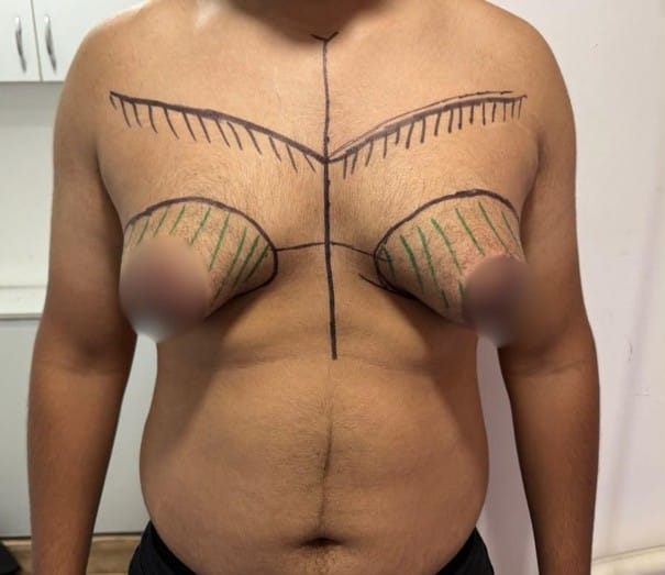 Front view of a man with black surgical markings on the chest for chest reduction or contouring; vertical center line, horizontal lines, curved upper markings, and green hatch marks near the nipples (nipples blurred).