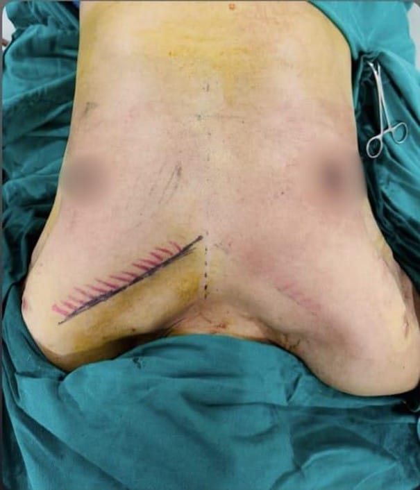 Intraoperative: chest and upper abdomen with incision line marked in pink, port entry sites blurred for patient privacy
