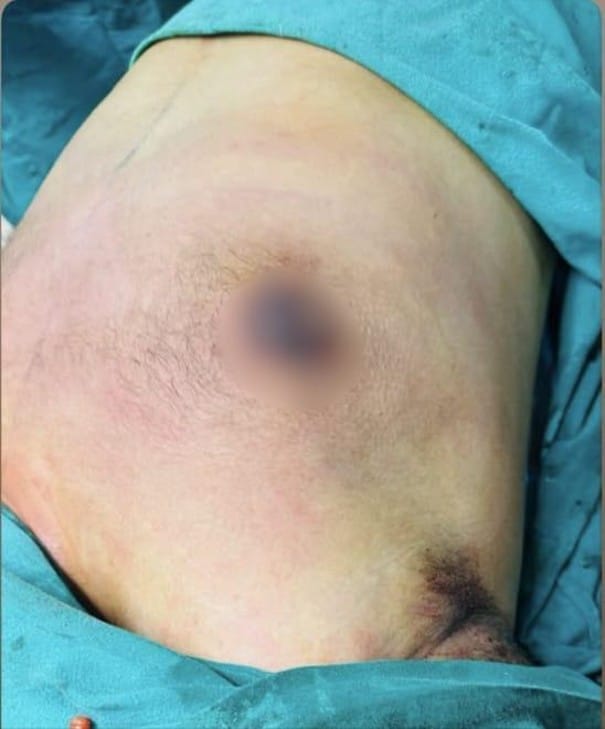 Close-up of a patient's upper leg showing extensive bruising, swelling, and a healing surgical wound near the knee with a blurred circular area in the mid-thigh, draped in teal surgical fabric.