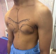 Person with post-surgical chest scars from top surgery, standing shirtless in a medical setting wearing blue shorts, healing visible.