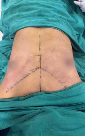 Back view of a patient after surgery with a vertical midline incision branching into a Y shape, surrounded by teal surgical drapes and mild bruising.