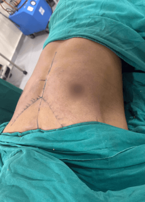 Postoperative abdomen with several incision lines and sutures, patient covered in green surgical drapes in an operating room.