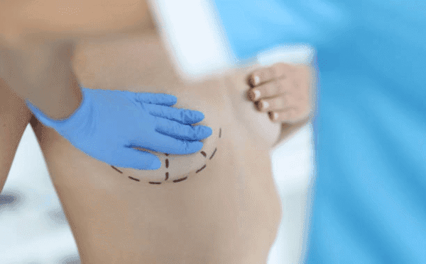 Medical professional in blue gloves drawing dashed surgical incision lines on a patient’s hip/abdomen area.