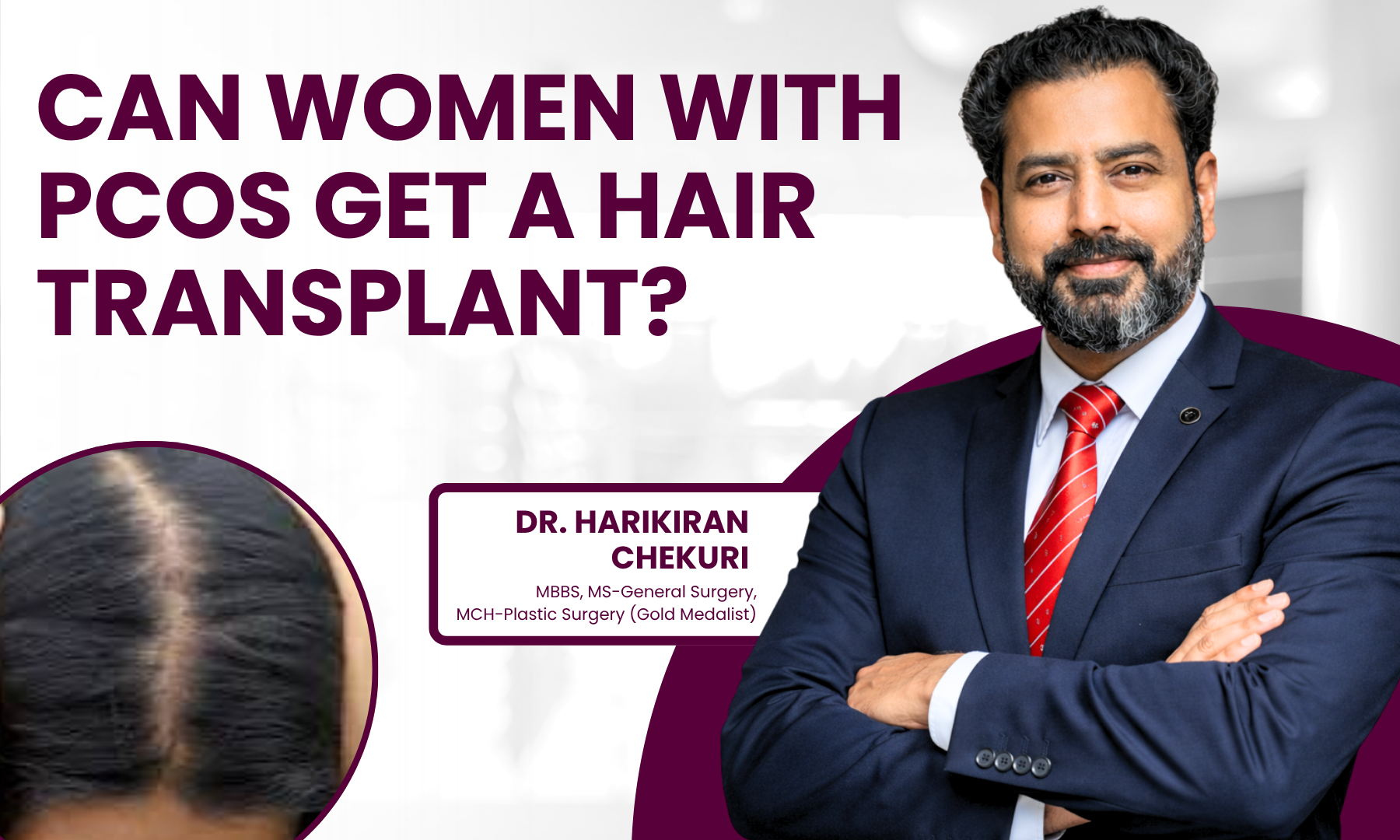 Can Women With PCOS Get a Hair Transplant