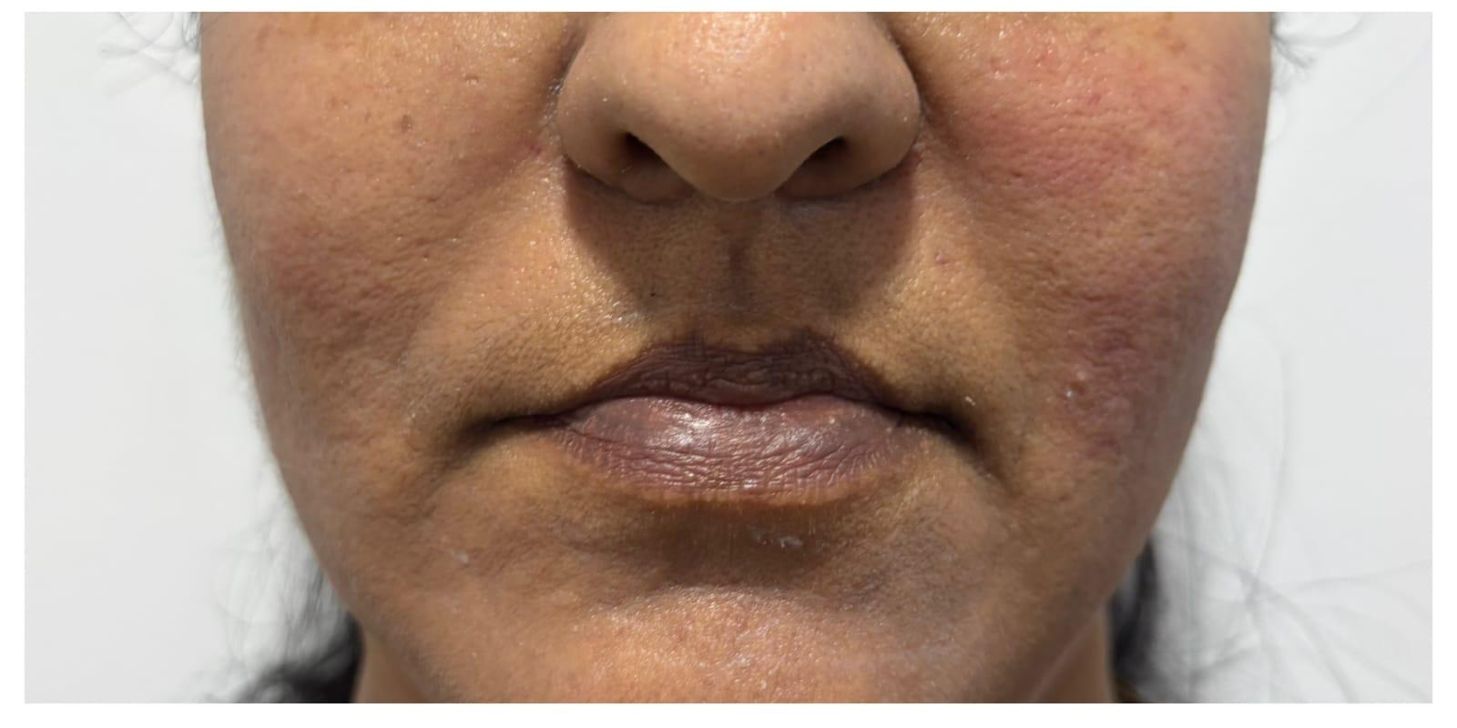 Close-up of the lower face showing dark skin tone and uneven pigmentation with small acne scars around the mouth and cheeks.
